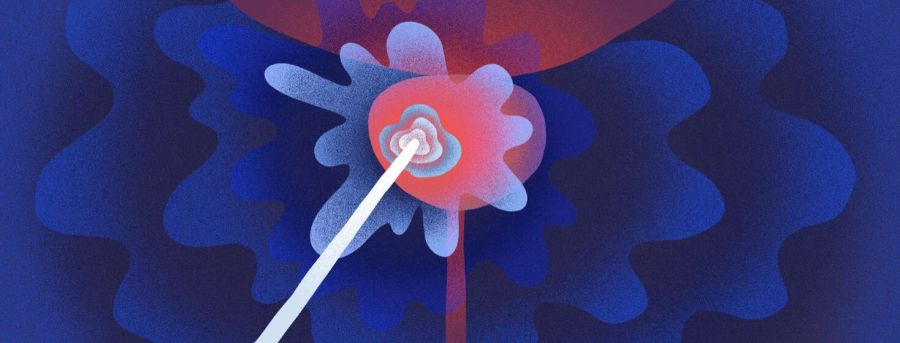 Putting the Freeze on Cancer With&nbsp;Cryotherapy